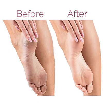 Rechargeable Electric Foot Callus Remover – Dual Speed Pedicure Tool